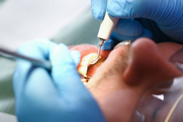 Best Emergency Root Canal Treatment in Bonnetsville, NC