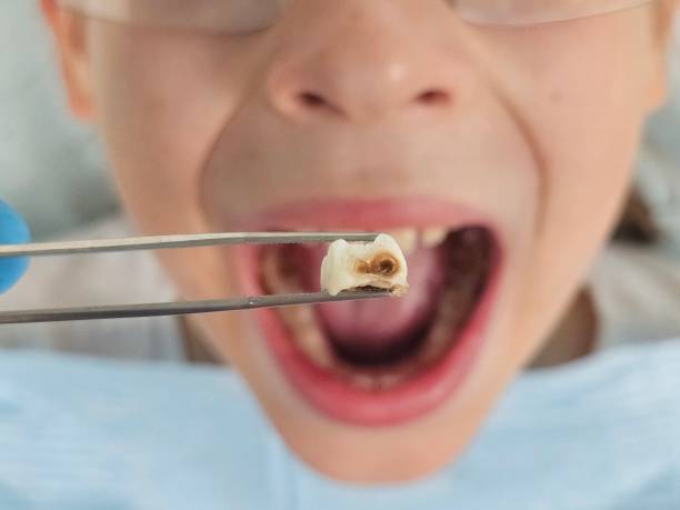 Best Emergency Tooth Extraction in Bonnetsville, NC